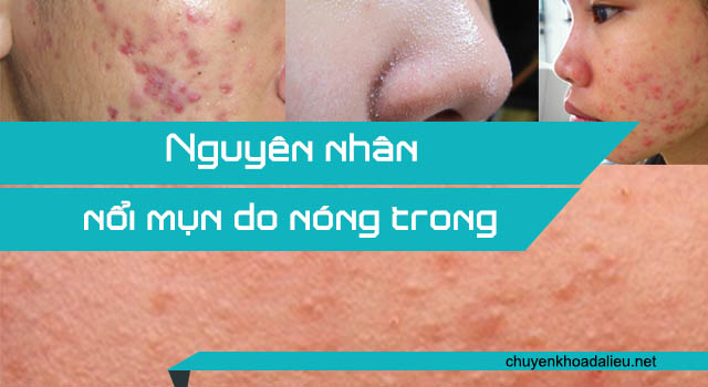 Nguyên nhân gây nên mụn do nóng trong