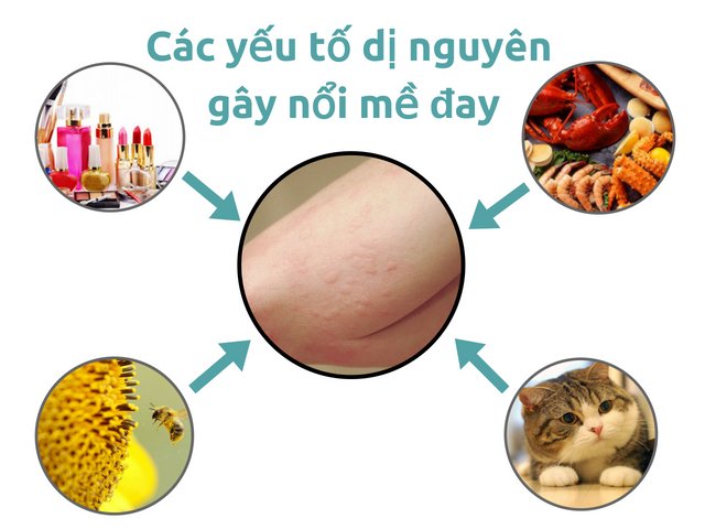 Nổi mề đay dị ứng là một trong các thể mề đay thường gặp