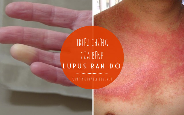 biến chứng của lupus ban đỏ1