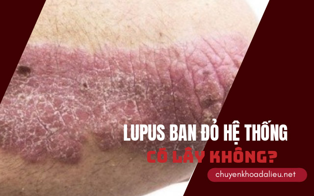 lupus ban đỏ hệ thống có lây không?