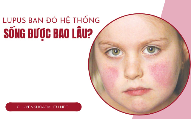 lupus ban đỏ hệ thống8