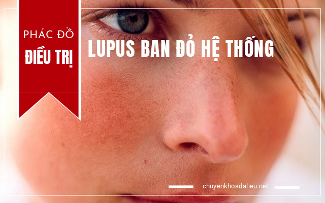 phác đồ điều trị lupus ban đỏ hệ thống