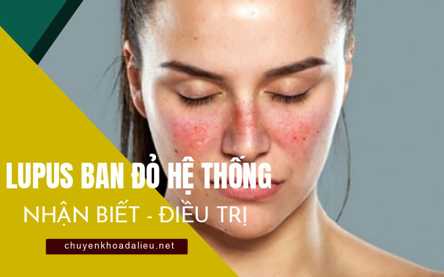 lupus ban đỏ hệ thống