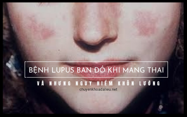 lupus ban đỏ khi mang thai