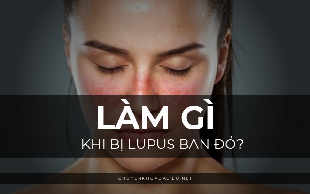 nguyên nhân gây ra bệnh lupus ban đỏ3