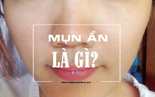 mụn ẩn là gì