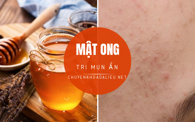 trị mụn ẩn bằng mật ong