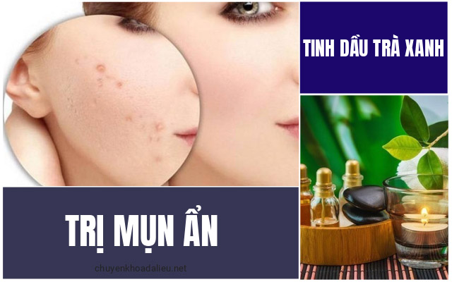 tinh dầu trà xanh trị mụn ẩn