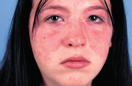 Nhận thức đúng độ nguy hiểm của bệnh Lupus ban đỏ