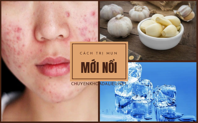 cách chữa mụn mới nổi