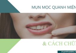 Mụn mọc quanh miệng là bệnh gì?