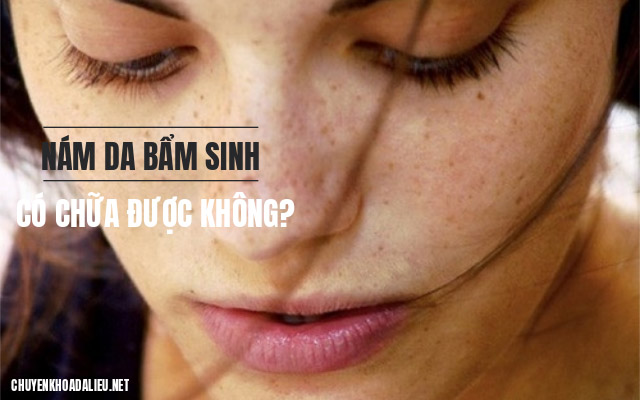 nám bẩm sinh