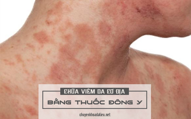 chữa viêm da cơ địa bằng thuốc Đông y 