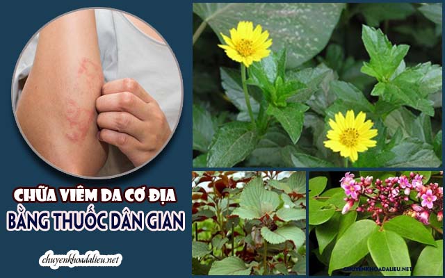 chữa viêm da cơ địa bằng thuốc dân gian