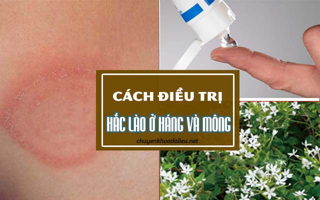 cách trị hắc lào ở háng và mông