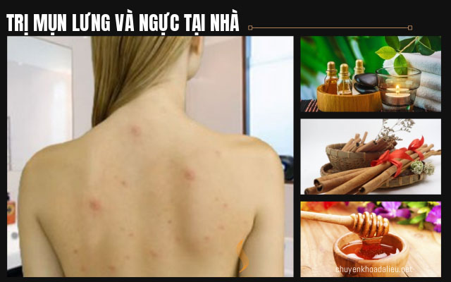 trị mụn ở lưng và ngực tại nhà 