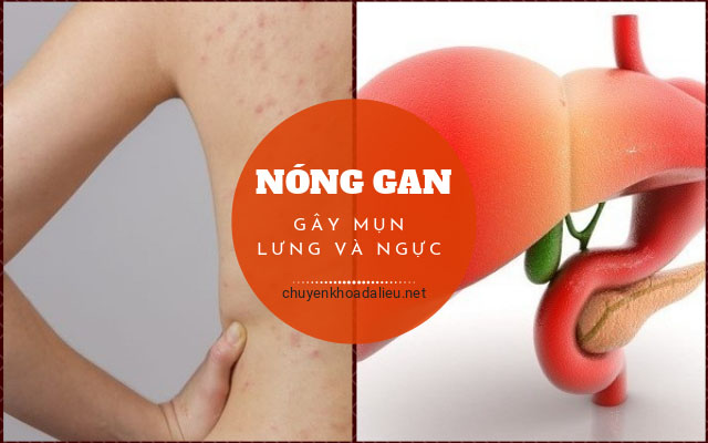 nóng gan gây mụn ở ngực và lưng