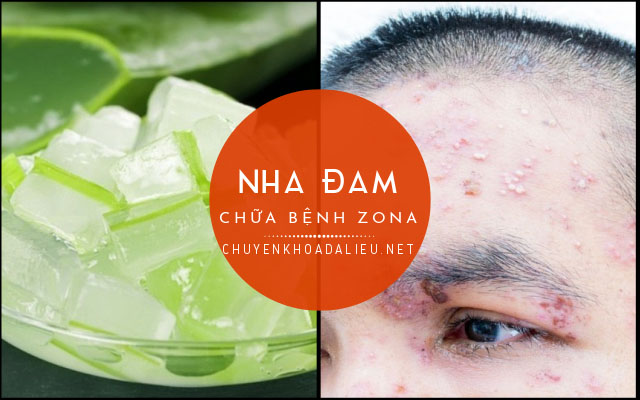 nha đam chữa bệnh zona