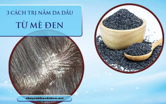 mè đen trị nấm da đầu