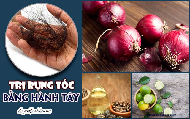 trị rụng tóc bằng hành tây