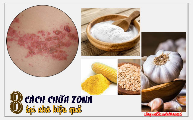 cách chữa zona thần kinh