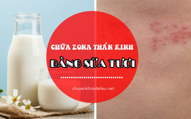 cách chữa zona thần kinh bằng sữa tươi