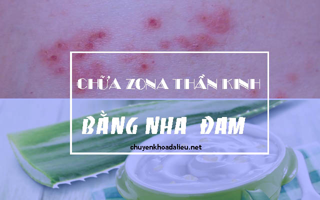 nha đam chữa zona thần kinh