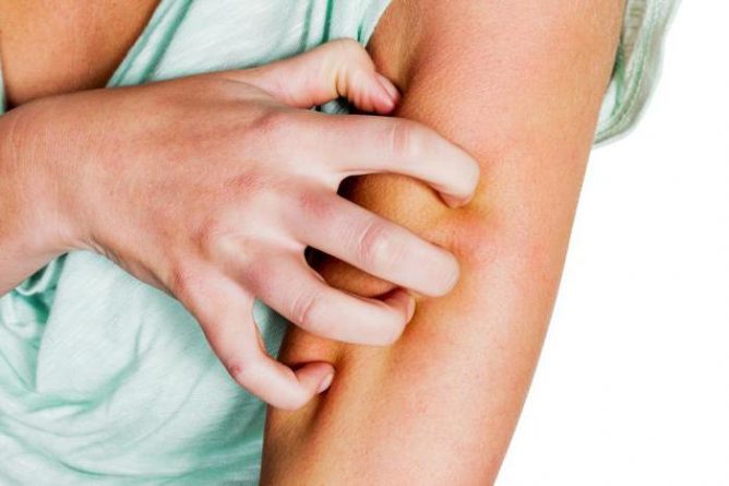 Ngứa là một dấu hiệu của bệnh lác đồng tiền