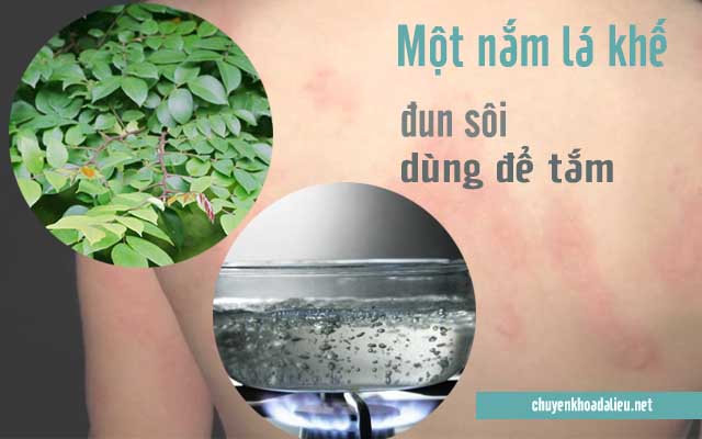 Tắm nước lá khế để chữa bệnh mề đay 