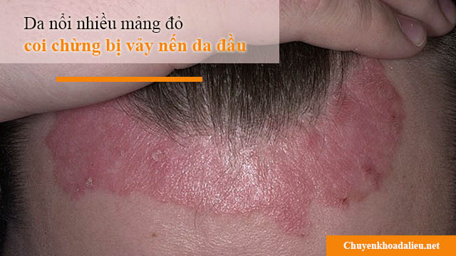 Da nổi nhiều mảng đỏ là dấu hiệu vẩy nến da đầu