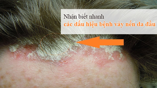 các dấu hiệu bệnh vẩy nến da đầu