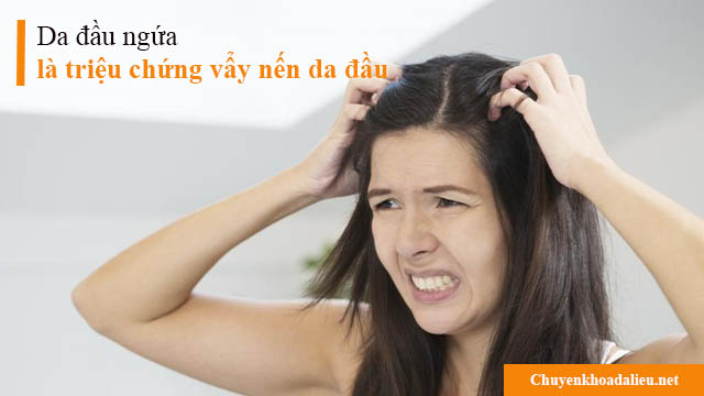 Da đầu ngứa là triệu chứng vẩy nến da đầu thường gặp