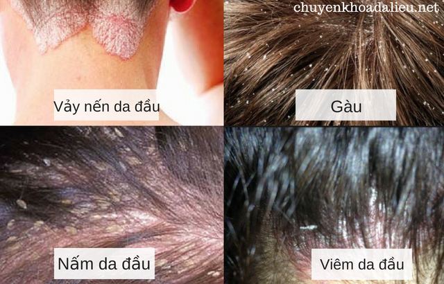 Phân biệt dấu hiệu bị vẩy nến da đầu với gàu, nấm da đầu và viêm da dầu