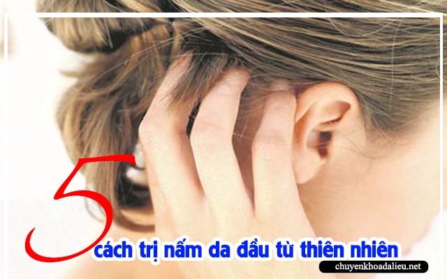  Cách trị nấm da đầu bằng dân gian