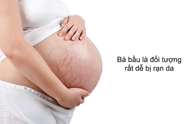 Các đối tượng hay bị rạn da