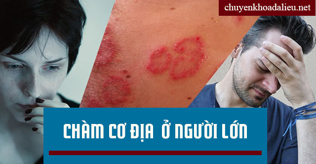 Triệu chứng bệnh chàm cơ địa ở người lớn Triệu chứng bệnh chàm cơ địa ở người lớn