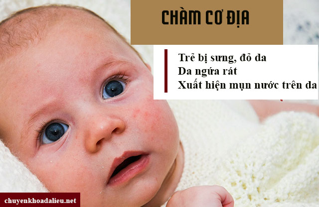 Các triệu chứng chàm cơ địa ở trẻ em 