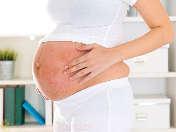 Bị vẩy nến có ảnh hưởng đến thai nhi không