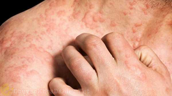 Mẹo giúp bạn ít bị ngứa hơn khi bị bệnh Eczema