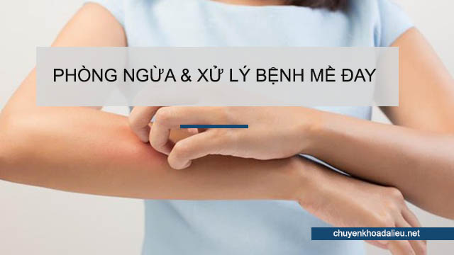 Cách phòng ngừa và xử lý bệnh mề đay