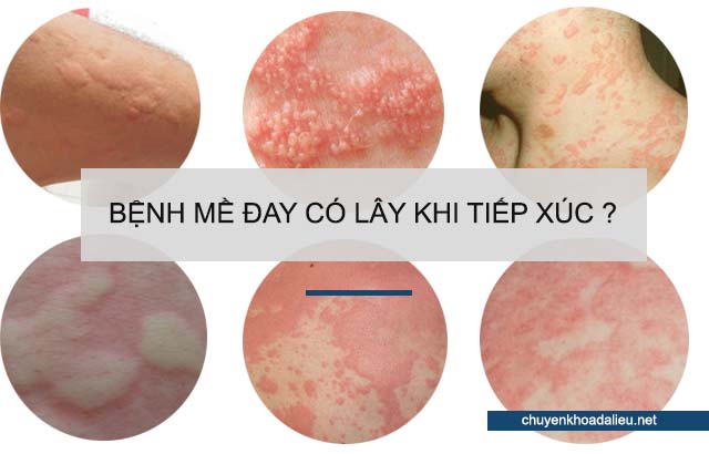 bệnh mề đay có lây không?