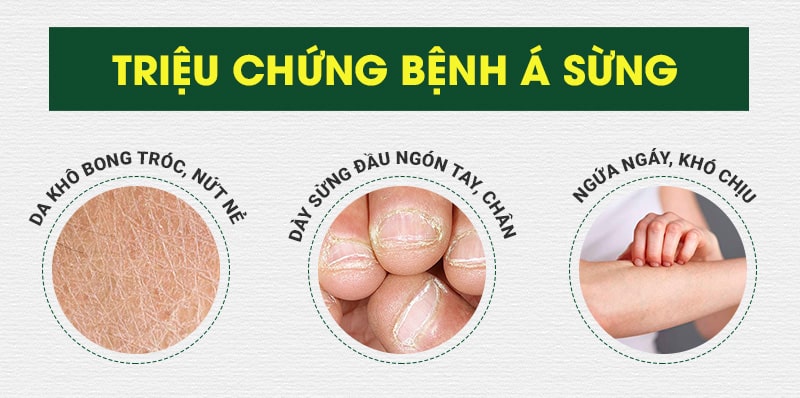 Hình ảnh bệnh á sừng tại các vị trí