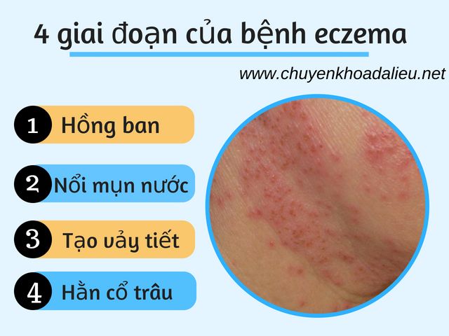 Các giai đoạn của bệnh eczema