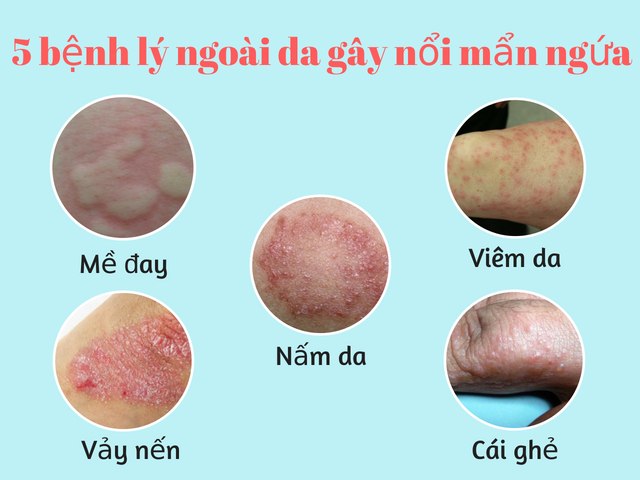 Các bệnh lý ngoài da gây mẩn ngứa