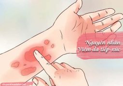 nguyên nhân gây bệnh viêm da tiếp xúc