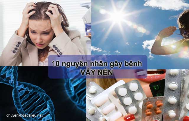 10 nguyên nhân gây ra bệnh vẩy nến