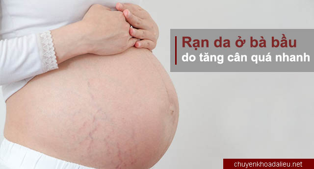chứng rạn da thường gặp ở phụ nữ mang thai