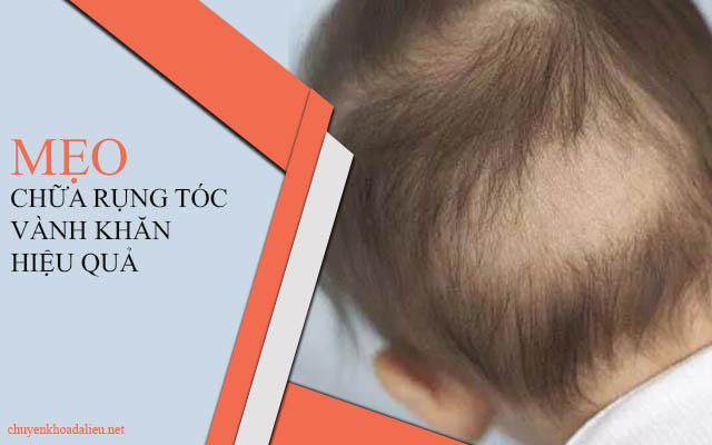 Rụng tóc vành khăn và những cách chữa trị hiệu quả