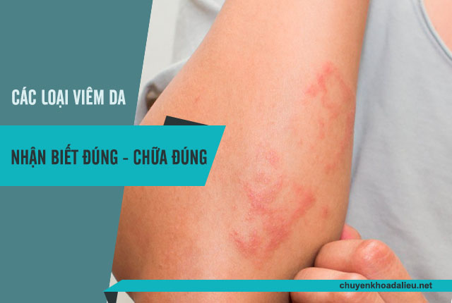 Bệnh viêm da có nhiều loại