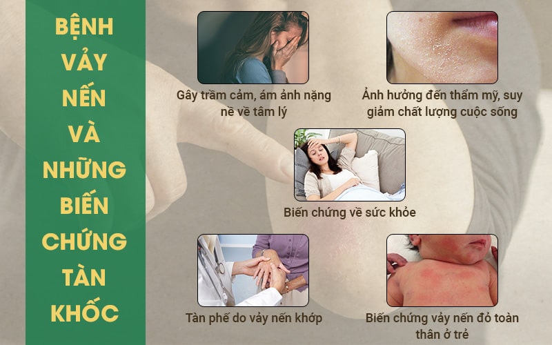 Bệnh vảy nến